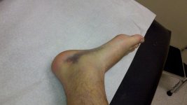 X12-Broken-Foot-14.jpg X12-Broken-Foot-14.jpg