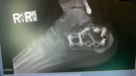 1418-Foot-XRays-01.jpg