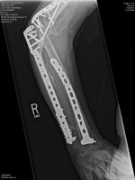 Right elbow_3.jpg