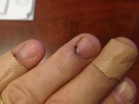 mashed fingers.jpg