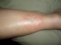 lyme.jpg