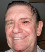 Eye Injury Day 0.jpg