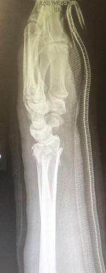 wristbone.jpg